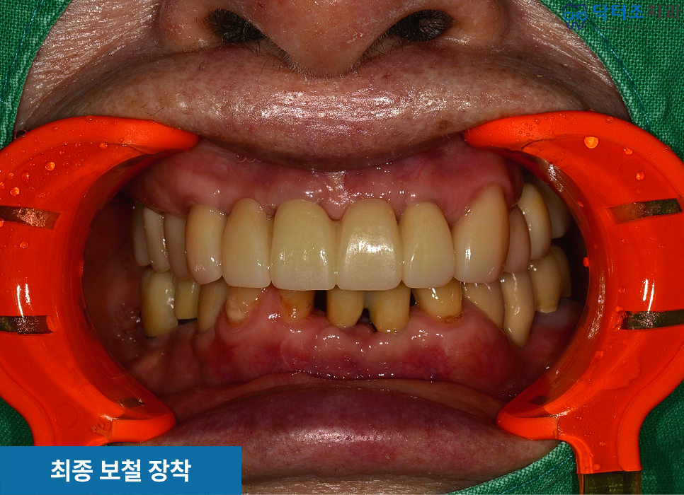 앞니완성