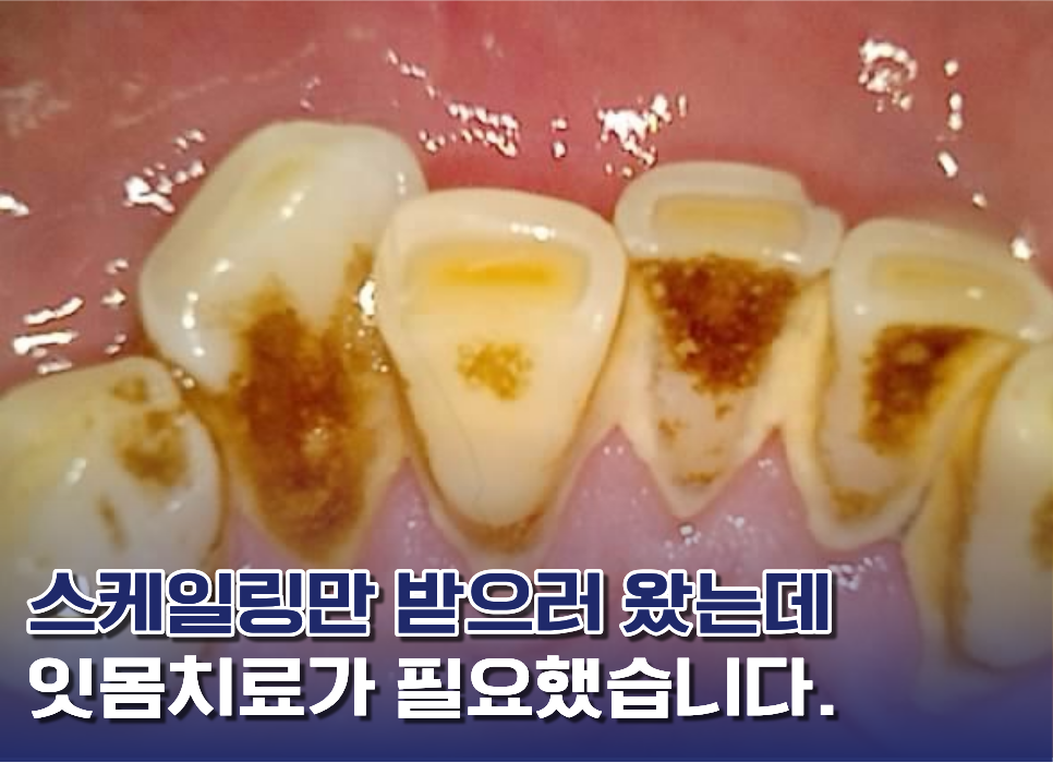잇몸치료