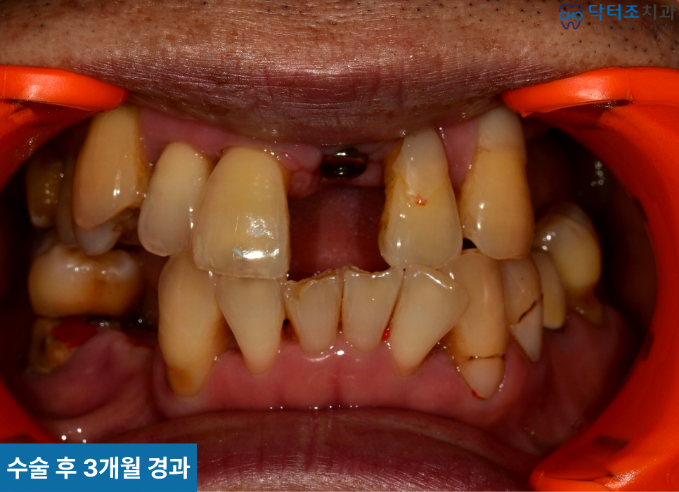 앞니수술