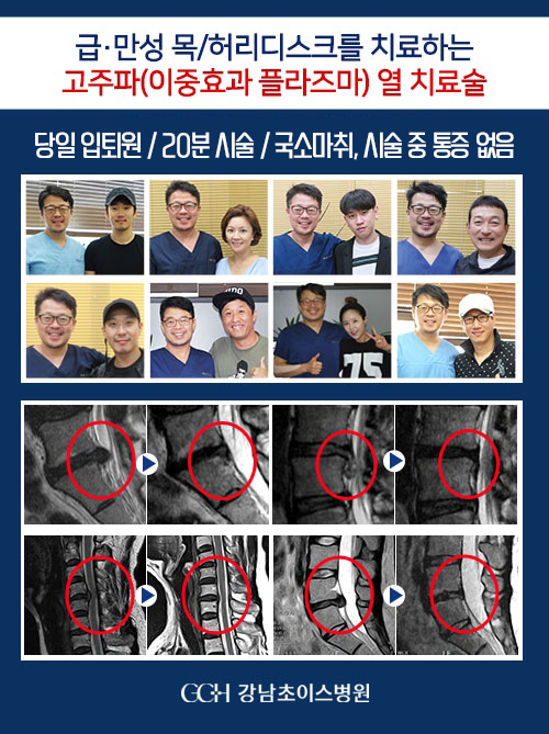 고주파 열치료술