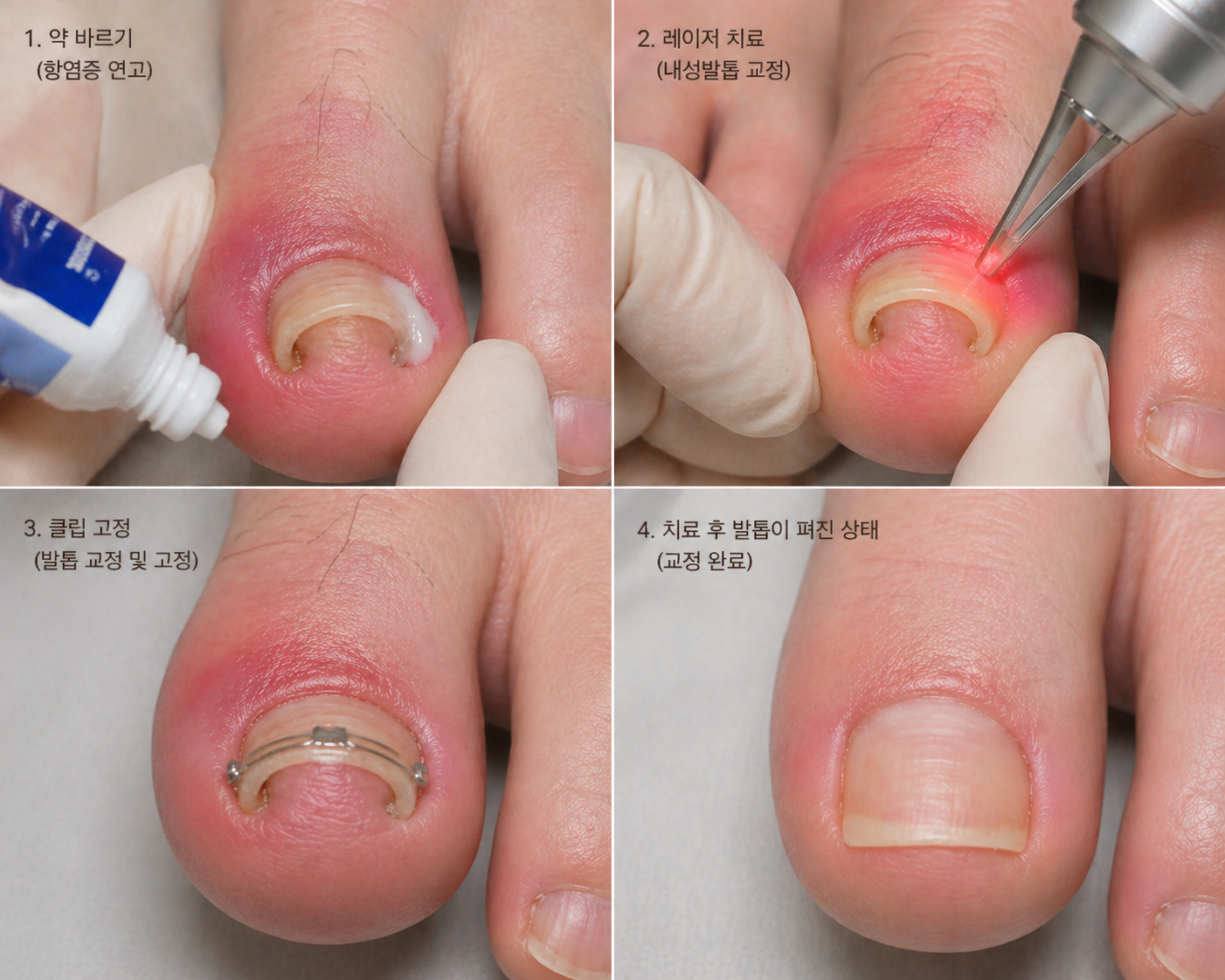 GV의원 내성발톱 치료 과정