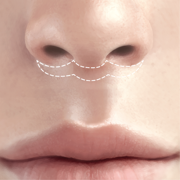 인중축소술 수술방법 02