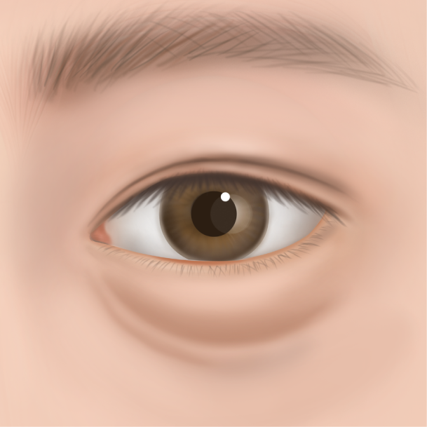 하안검 수술방법 01