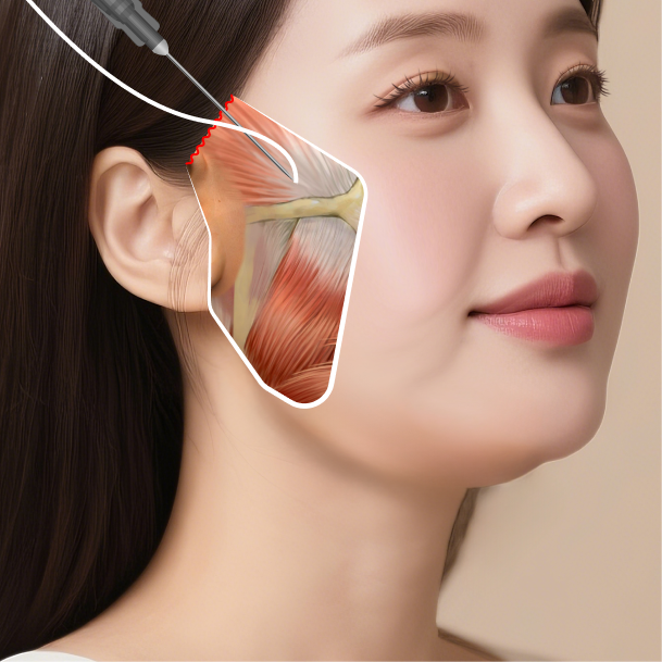 미니트리 수술방법 02