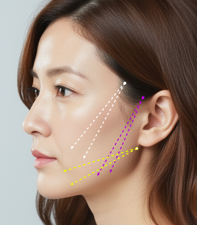 퀵트리 부위별 디테일 - 하안면강화형