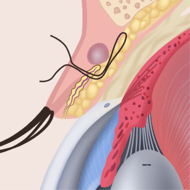 눈매교정 수술방법 02