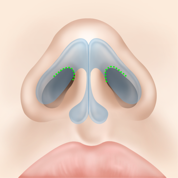 비개방형 코성형 수술방법01