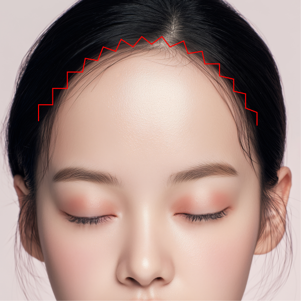 이마거상술 절개이마거상 수술방법 01