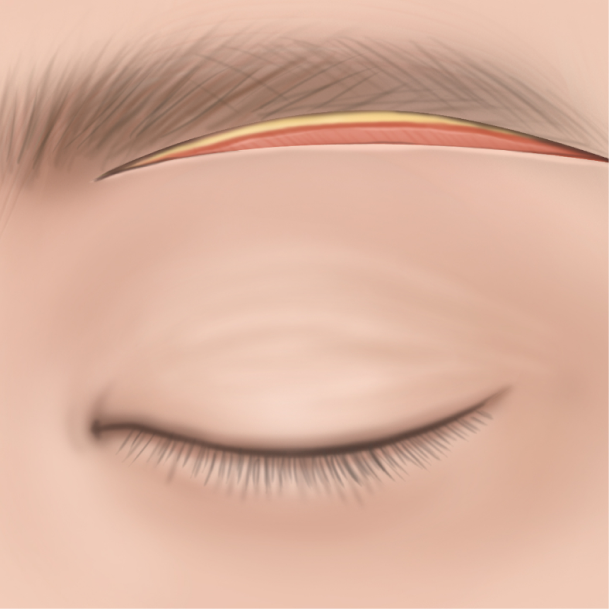 눈썹밑거상술 수술방법 02