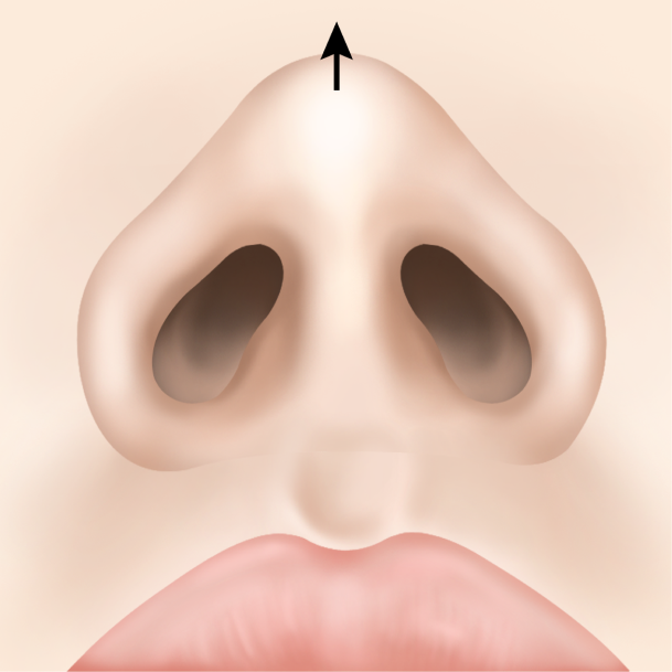 비개방형 코성형 수술방법04