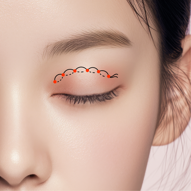 쌍꺼풀 수술방법 02