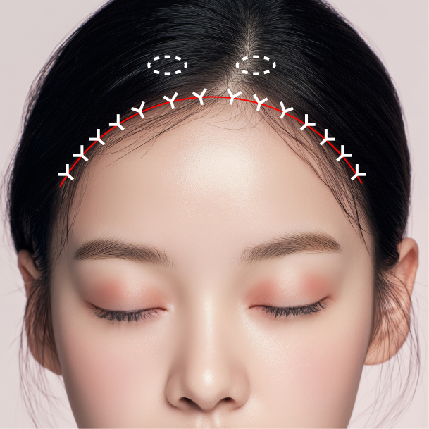 이마축소술 수술방법 04