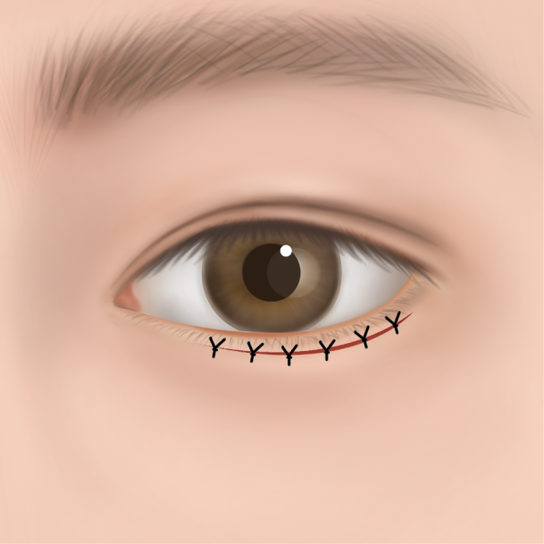 하안검 수술방법 04