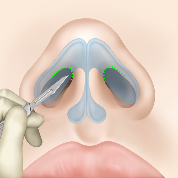 비개방형 코성형 수술방법02