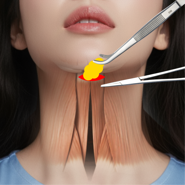 이중턱근육묶기 수술방법 03