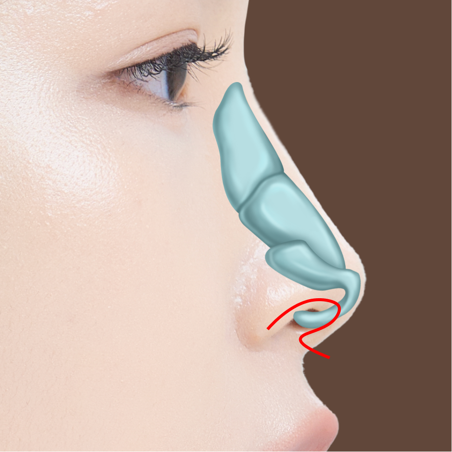 개방형 코성형 수술방법 02