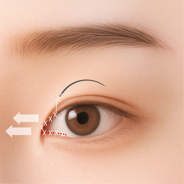 앞트임 수술방법 03