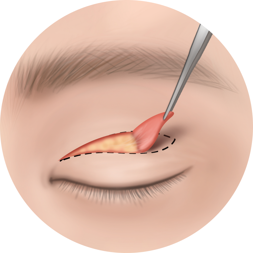 상안검수술과 눈썹하거상술 차이점 - 부산상안검수술