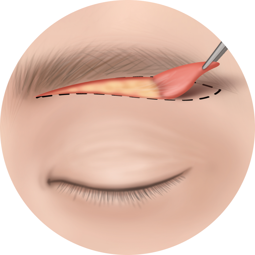 상안검수술과 눈썹하거상술 차이점 - 부산눈썹하거상술