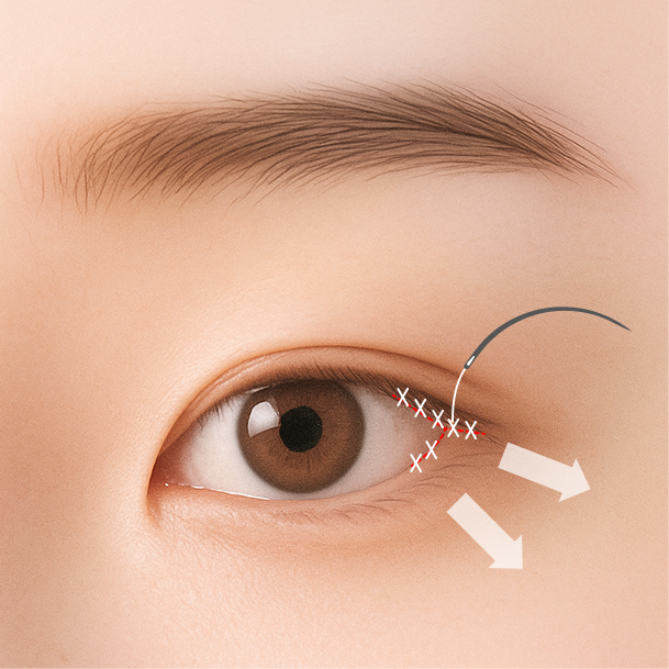 뒤트임 수술방법 03