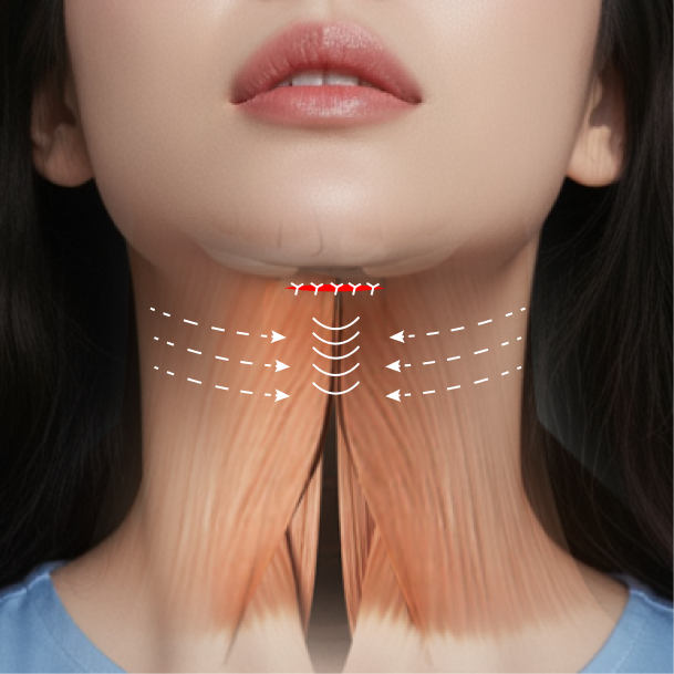 이중턱근육묶기 수술방법 04