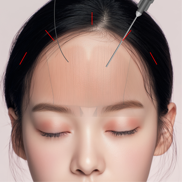 이마거상술 내시경이마거상 수술방법 02