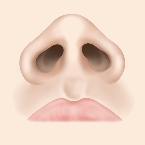 콧볼축소술 내측절개 수술방법 01