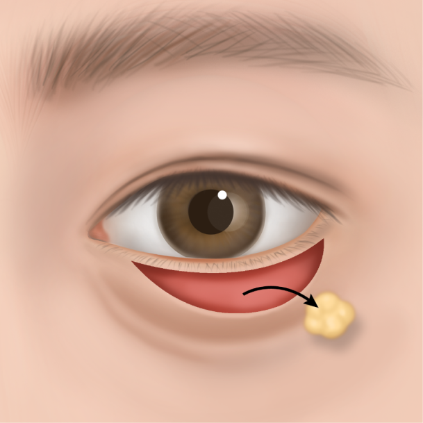 하안검 수술방법 03