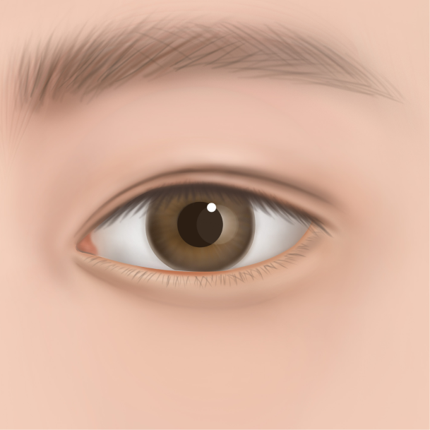 눈밑지방재배치 수술방법 04