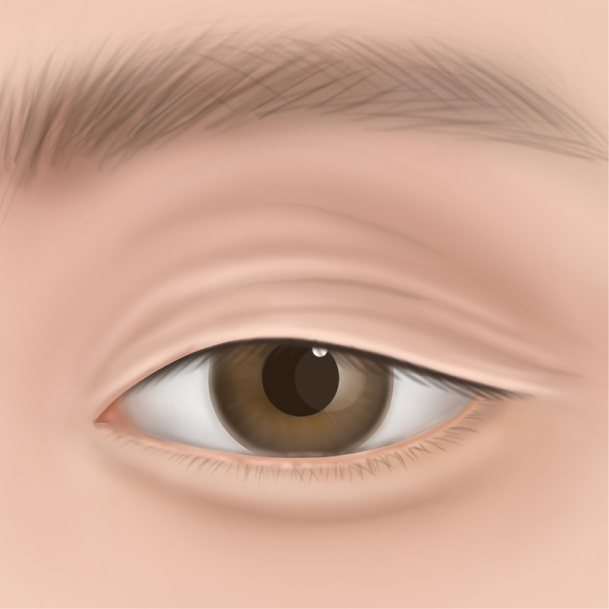 눈썹밑거상술 수술방법 01