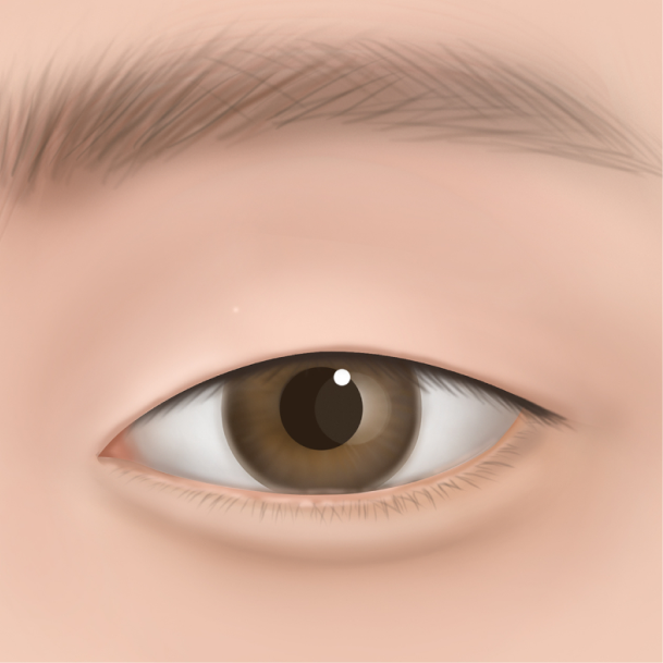 눈썹밑거상술 수술방법 04