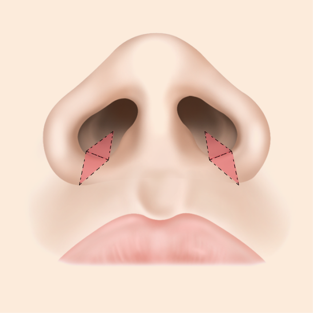 콧볼축소술 내측절개 수술방법 02