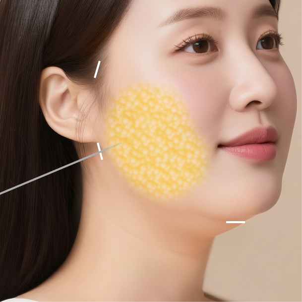 지방흡입 수술방법03