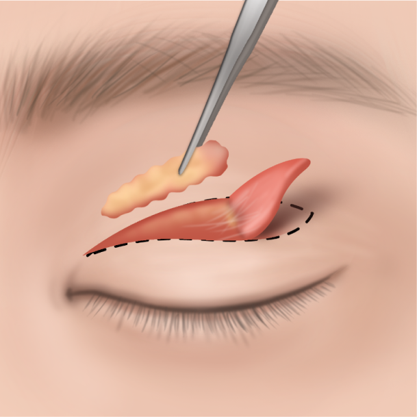 상안검 수술방법 03