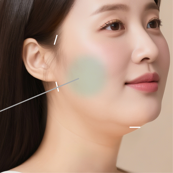 지방흡입 수술방법02