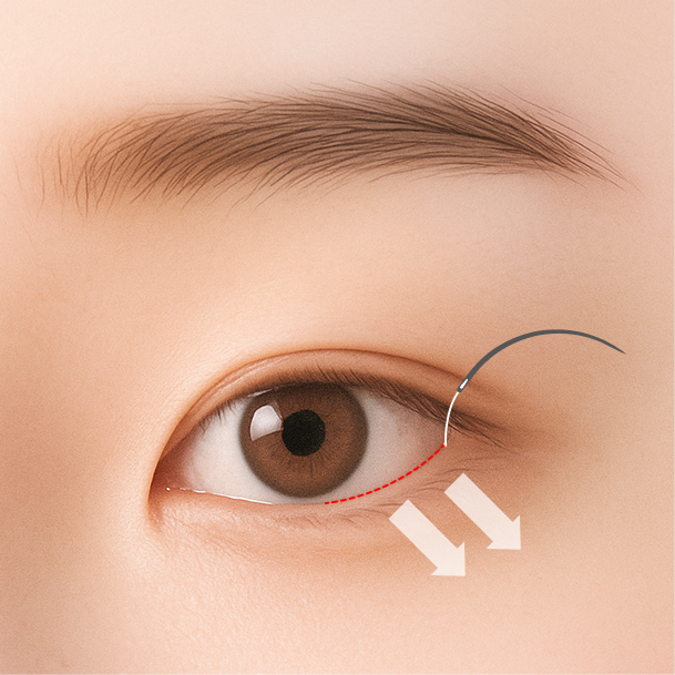 밑트임 수술방법 03