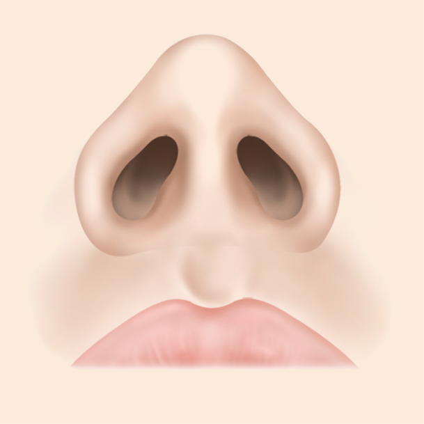 콧볼축소술 비절개 수술방법 04