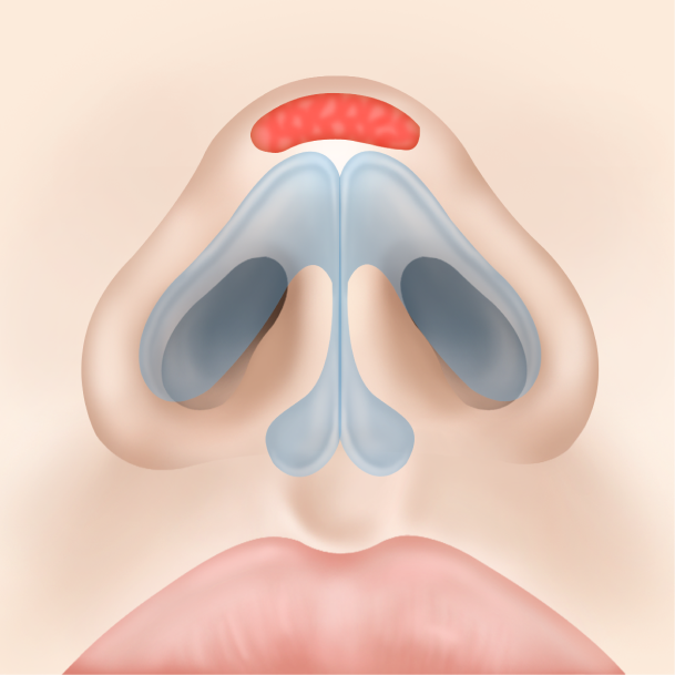 비개방형 코성형 수술방법03
