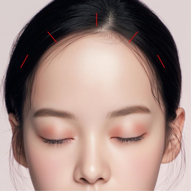 이마거상술 내시경이마거상 수술방법 01