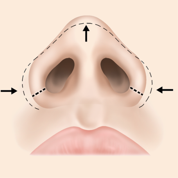 콧볼축소술 내측절개 수술방법 03