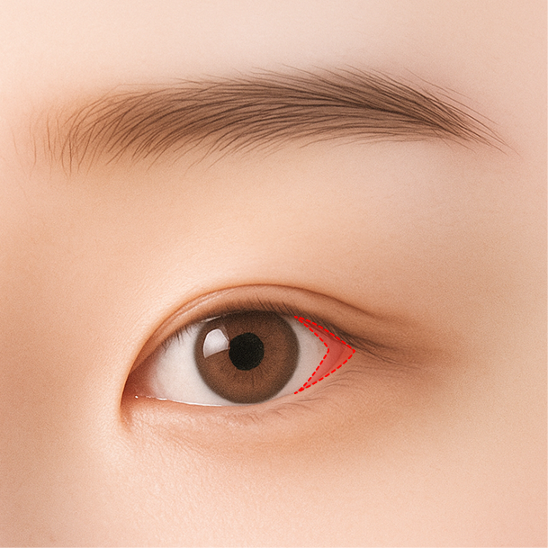 뒤트임 수술방법 02