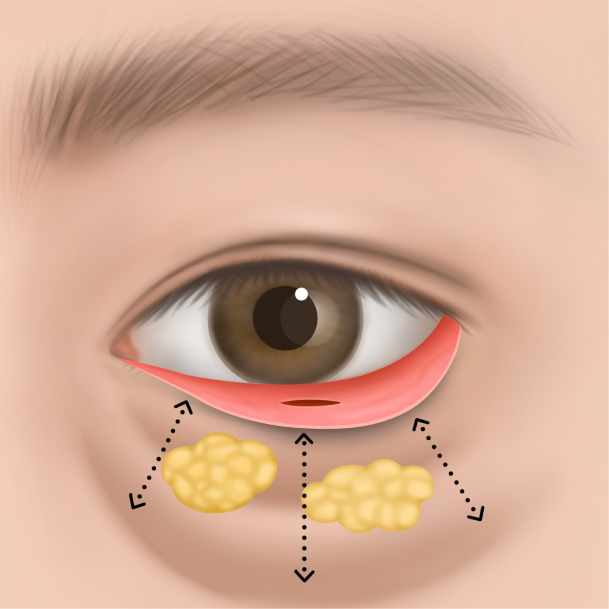 눈밑지방재배치 수술방법 02