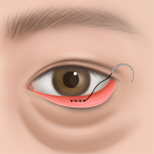 눈밑지방재배치 수술방법 03