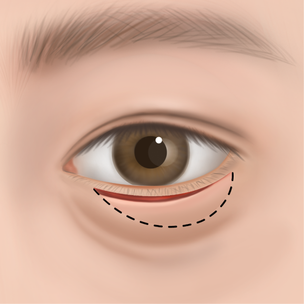 하안검 수술방법 02