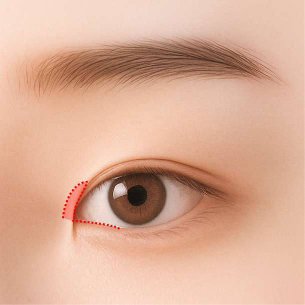 앞트임 수술방법 02