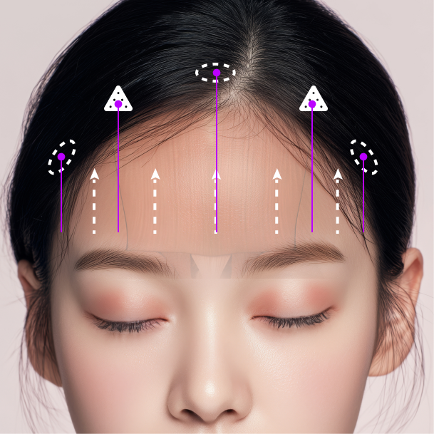 이마거상술 내시경이마거상 수술방법 03