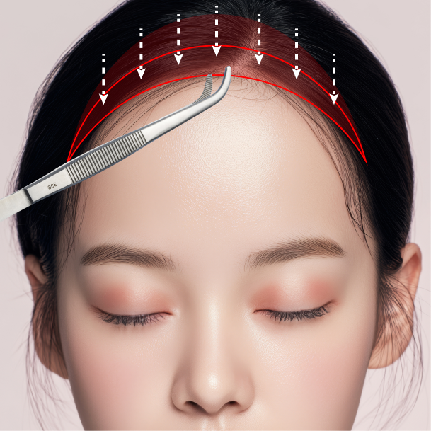 이마축소술 수술방법 03