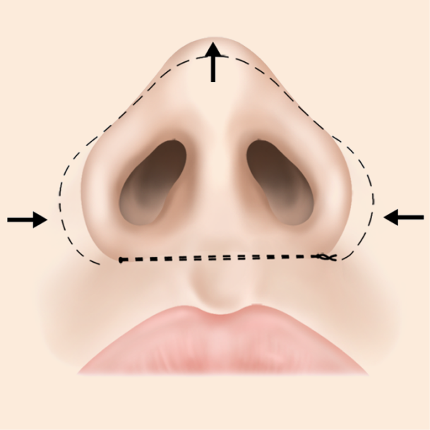 콧볼축소술 비절개 수술방법 03