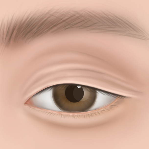 상안검 수술방법 01