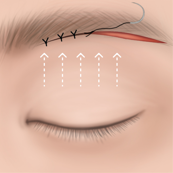 눈썹밑거상술 수술방법 03
